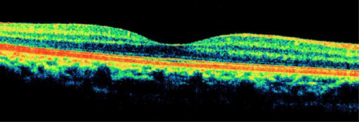 Bild 1: Optischer Schnitt durch eine gesunde Netzhaut (Macula) 