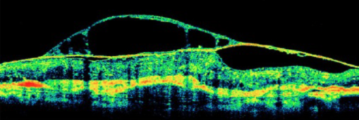 Bild 3: Optischer Schnitt durch erkrankte Netzhaut (cystoides Maculaödem)